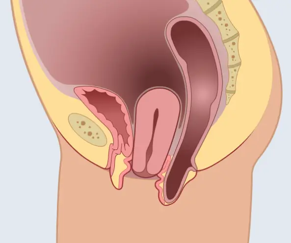 genitale prolaps Mirha